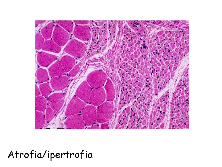 Atrofia/ipertrofia 