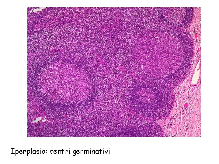 Iperplasia: centri germinativi 