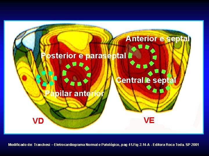 Anterior e septal Posterior e paraseptal Central e septal Papilar anterior VD VE Modificado