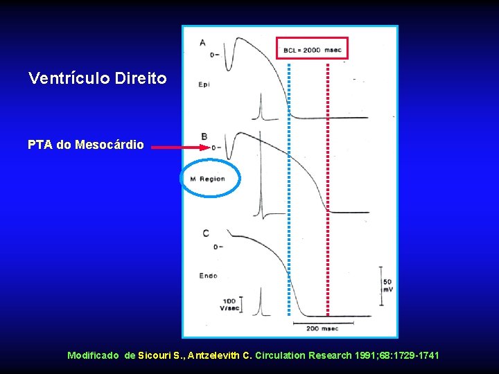 Ventrículo Direito PTA do Mesocárdio Modificado de Sicouri S. , Antzelevith C. Circulation Research