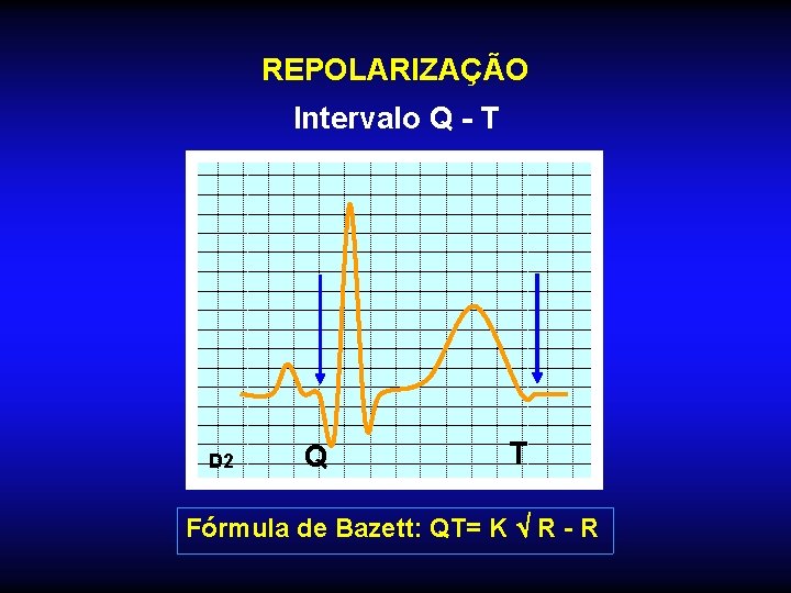 REPOLARIZAÇÃO Intervalo Q - T D 2 Q T Fórmula de Bazett: QT= K