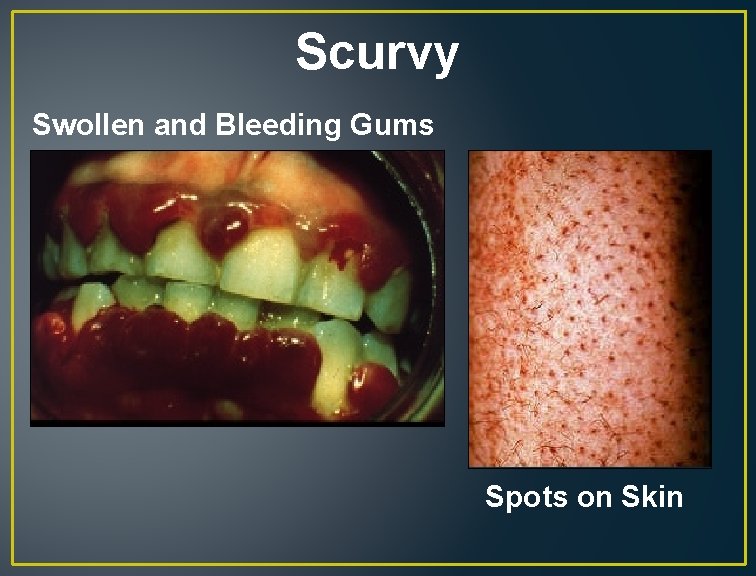 Scurvy Swollen and Bleeding Gums Spots on Skin 