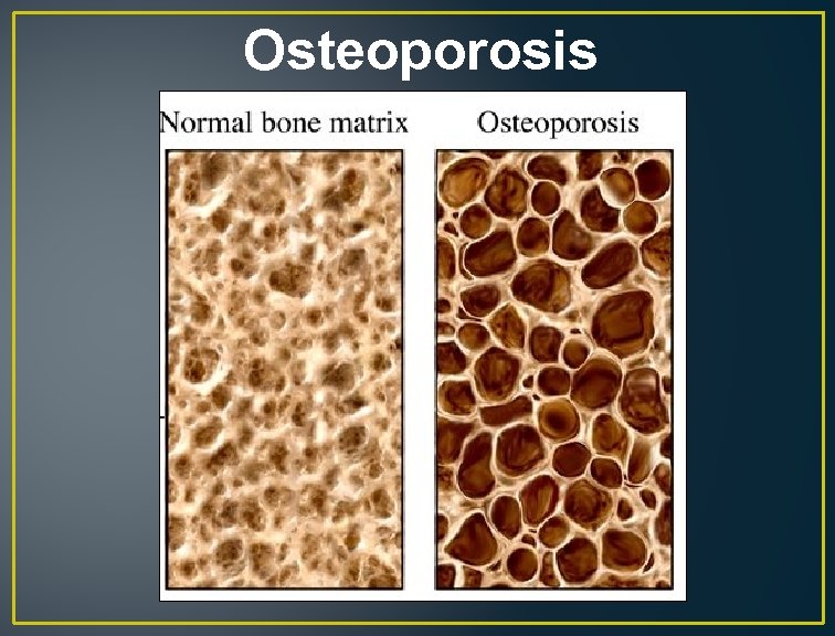 Osteoporosis 