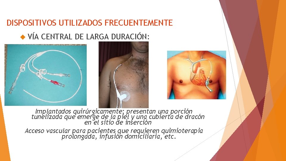 DISPOSITIVOS UTILIZADOS FRECUENTEMENTE VÍA CENTRAL DE LARGA DURACIÓN: Implantados quirúrgicamente; presentan una porción tunelizada