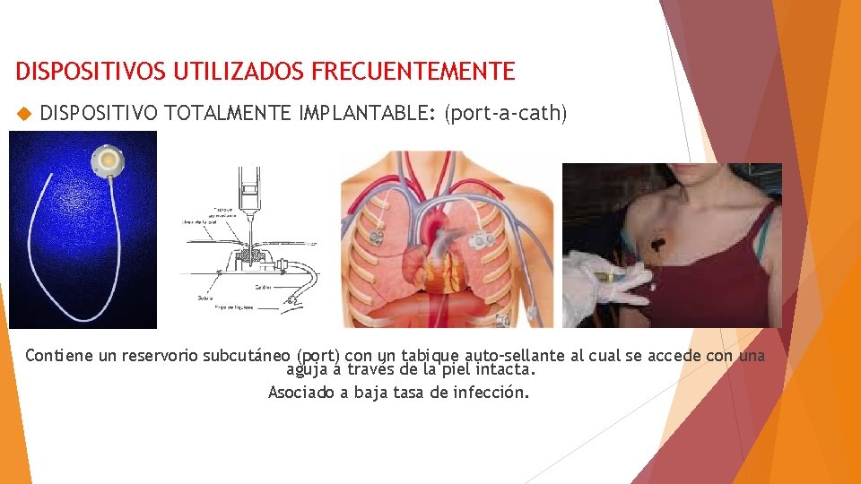 DISPOSITIVOS UTILIZADOS FRECUENTEMENTE DISPOSITIVO TOTALMENTE IMPLANTABLE: (port-a-cath) Contiene un reservorio subcutáneo (port) con un