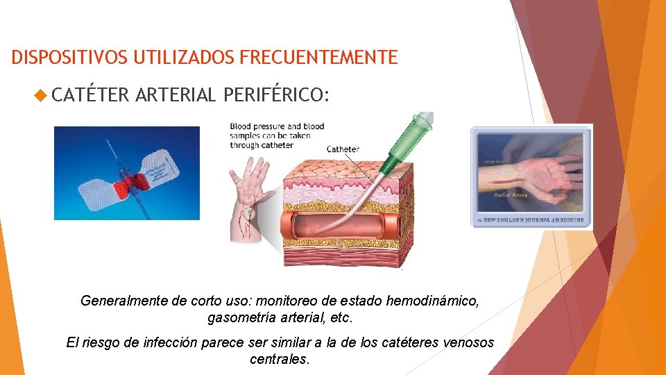 DISPOSITIVOS UTILIZADOS FRECUENTEMENTE CATÉTER ARTERIAL PERIFÉRICO: Generalmente de corto uso: monitoreo de estado hemodinámico,