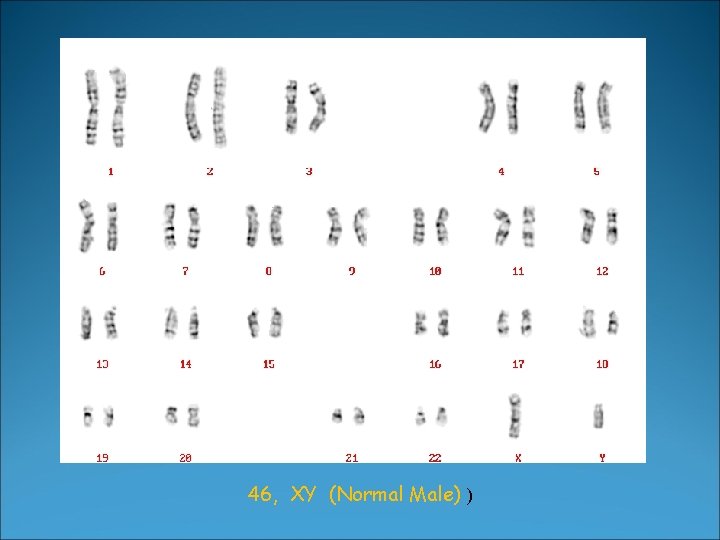 46, XY (Normal Male) ) 