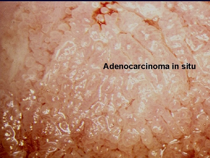 Adenocarcinoma in situ Adenocarcinoma in situ