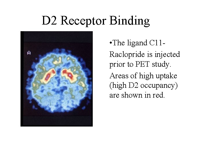 D 2 Receptor Binding • The ligand C 11 Raclopride is injected prior to