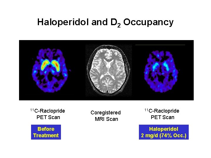 Haloperidol and D 2 Occupancy 11 C-Raclopride PET Scan Before Treatment Coregistered MRI Scan