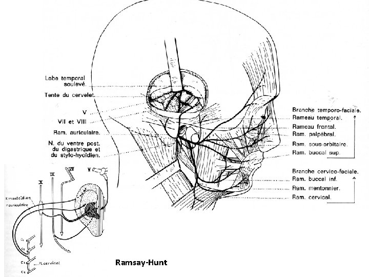 Ramsay-Hunt 