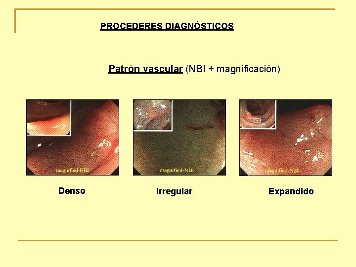 PROCEDERES DIAGNÓSTICOS Patrón vascular (NBI + magnificación) Denso Irregular Expandido 