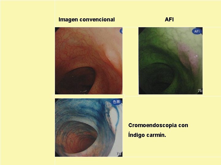 Imagen convencional AFI Cromoendoscopia con Índigo carmín. 