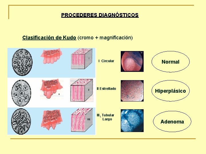 PROCEDERES DIAGNÓSTICOS Clasificación de Kudo (cromo + magnificación) I Circular Normal II Estrellado Hiperplásico