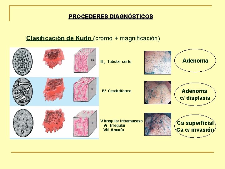 PROCEDERES DIAGNÓSTICOS Clasificación de Kudo (cromo + magnificación) IIIS Tubular corto IV Cerebriforme V