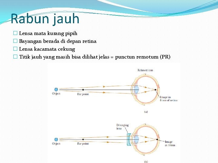 Rabun jauh � Lensa mata kurang pipih � Bayangan berada di depan retina �