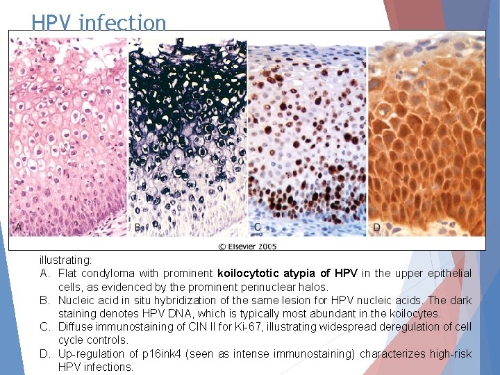 HPV infection illustrating: A. Flat condyloma with prominent koilocytotic atypia of HPV in the