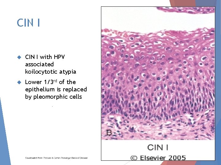 CIN I with HPV associated koilocytotic atypia Lower 1/3 rd of the epithelium is