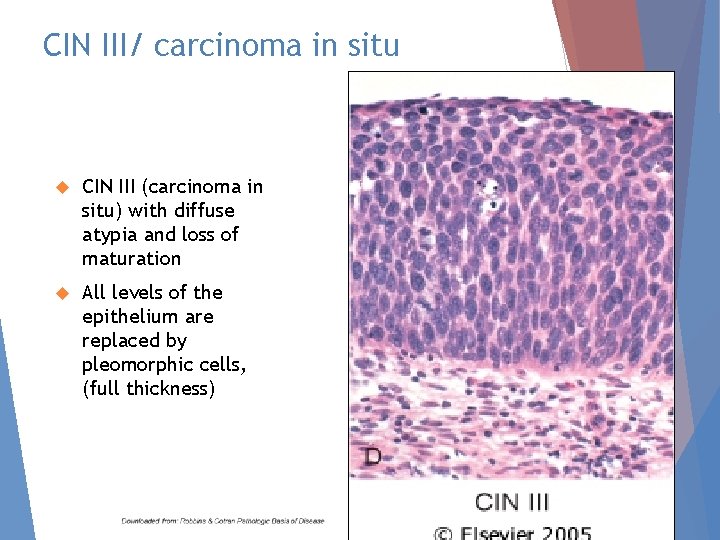 CIN III/ carcinoma in situ CIN III (carcinoma in situ) with diffuse atypia and