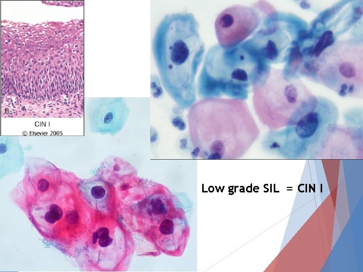 Low grade SIL = CIN I 