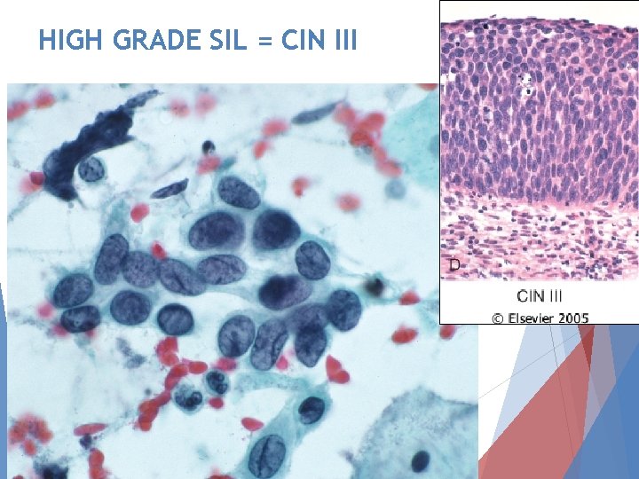 HIGH GRADE SIL = CIN III 