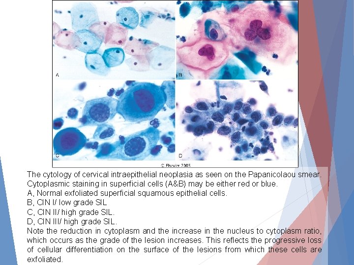 The cytology of cervical intraepithelial neoplasia as seen on the Papanicolaou smear. Cytoplasmic staining