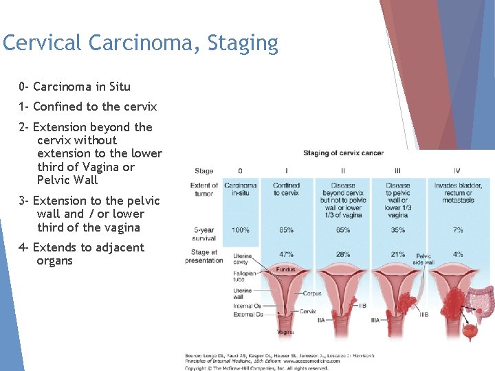 Cervical Carcinoma, Staging 0 - Carcinoma in Situ 1 - Confined to the cervix