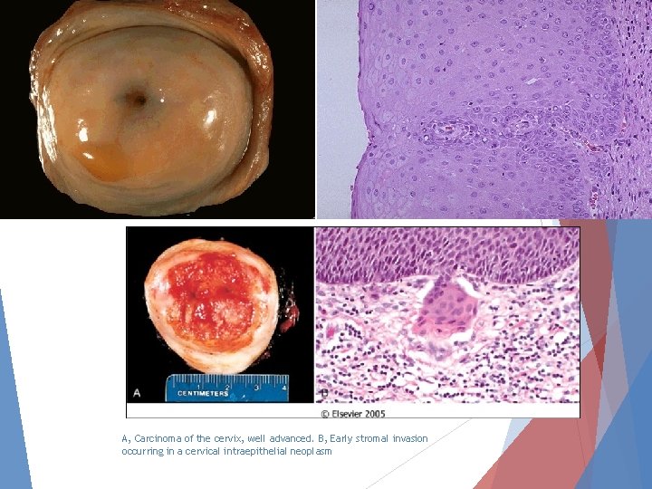 A, Carcinoma of the cervix, well advanced. B, Early stromal invasion occurring in a