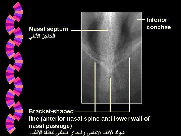 Nasal septum ﺍﻟﺤﺎﺟﺰ ﺍﻷﻨﻔﻲ Inferior conchae Bracket-shaped line (anterior nasal spine and lower wall Nasal septum ﺍﻟﺤﺎﺟﺰ ﺍﻷﻨﻔﻲ Inferior conchae Bracket-shaped line (anterior nasal spine and lower wall
