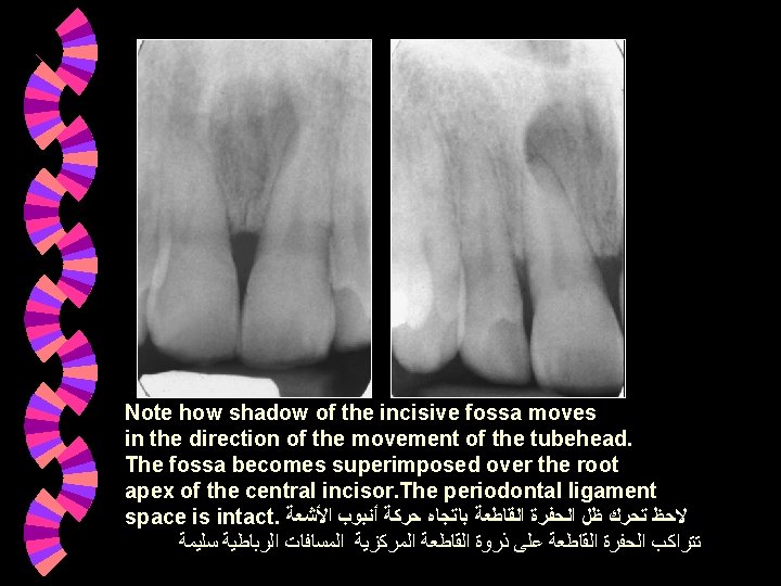 Note how shadow of the incisive fossa moves in the direction of the movement Note how shadow of the incisive fossa moves in the direction of the movement
