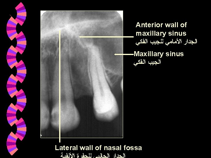 Anterior wall of maxillary sinus ﺍﻟﺠﺪﺍﺭ ﺍﻷﻤﺎﻣﻲ ﻟﻠﺠﻴﺐ ﺍﻟﻔﻜﻲ Maxillary sinus ﺍﻟﺠﻴﺐ ﺍﻟﻔﻜﻲ Lateral Anterior wall of maxillary sinus ﺍﻟﺠﺪﺍﺭ ﺍﻷﻤﺎﻣﻲ ﻟﻠﺠﻴﺐ ﺍﻟﻔﻜﻲ Maxillary sinus ﺍﻟﺠﻴﺐ ﺍﻟﻔﻜﻲ Lateral