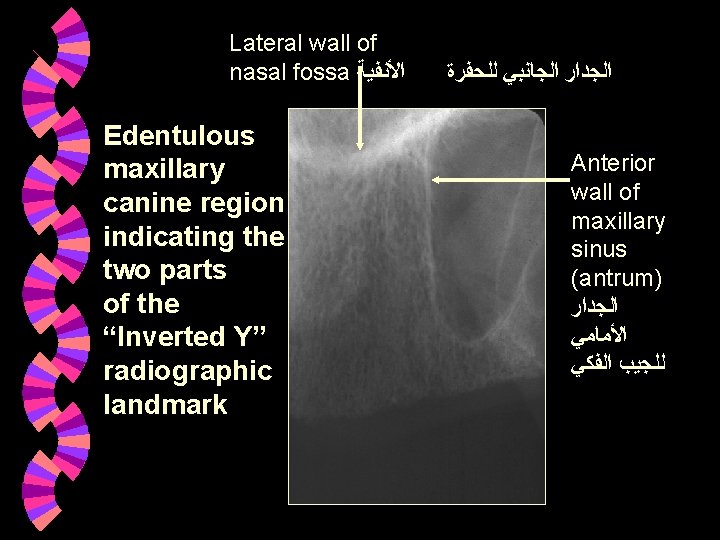 Lateral wall of nasal fossa ﺍﻷﻨﻔﻴﺔ Edentulous maxillary canine region indicating the two parts Lateral wall of nasal fossa ﺍﻷﻨﻔﻴﺔ Edentulous maxillary canine region indicating the two parts