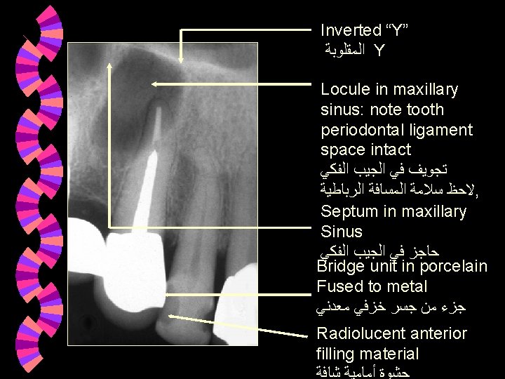 Inverted “Y” ﺍﻟﻤﻘﻠﻮﺑﺔ Y Locule in maxillary sinus: note tooth periodontal ligament space intact Inverted “Y” ﺍﻟﻤﻘﻠﻮﺑﺔ Y Locule in maxillary sinus: note tooth periodontal ligament space intact