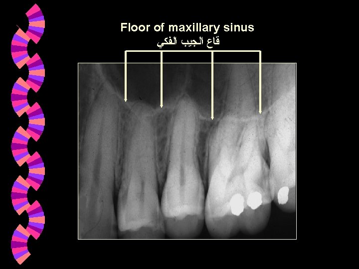 Floor of maxillary sinus ﻗﺎﻉ ﺍﻟﺠﻴﺐ ﺍﻟﻔﻜﻲ Floor of maxillary sinus ﻗﺎﻉ ﺍﻟﺠﻴﺐ ﺍﻟﻔﻜﻲ