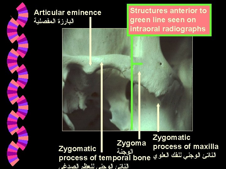 Articular eminence ﺍﻟﺒﺎﺭﺯﺓ ﺍﻟﻤﻔﺼﻠﻴﺔ Structures anterior to green line seen on intraoral radiographs Zygomatic Articular eminence ﺍﻟﺒﺎﺭﺯﺓ ﺍﻟﻤﻔﺼﻠﻴﺔ Structures anterior to green line seen on intraoral radiographs Zygomatic