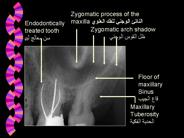 Zygomatic process of the Endodontically maxilla ﺍﻟﻨﺎﺗﺊ ﺍﻟﻮﺟﻨﻲ ﻟﻠﻔﻚ ﺍﻟﻌﻠﻮﻱ Zygomatic arch shadow treated Zygomatic process of the Endodontically maxilla ﺍﻟﻨﺎﺗﺊ ﺍﻟﻮﺟﻨﻲ ﻟﻠﻔﻚ ﺍﻟﻌﻠﻮﻱ Zygomatic arch shadow treated