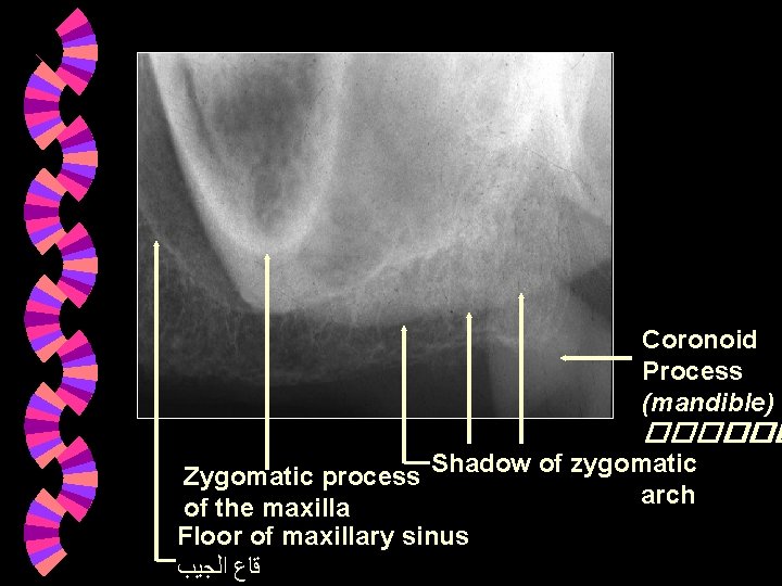 Coronoid Process (mandible) ������ Zygomatic process Shadow of zygomatic arch of the maxilla Floor Coronoid Process (mandible) ������ Zygomatic process Shadow of zygomatic arch of the maxilla Floor