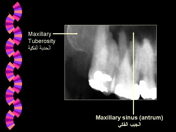 Maxillary Tuberosity ﺍﻟﺤﺪﺑﺔ ﺍﻟﻔﻜﻴﺔ Maxillary sinus (antrum) ﺍﻟﺠﻴﺐ ﺍﻟﻔﻜﻲ Maxillary Tuberosity ﺍﻟﺤﺪﺑﺔ ﺍﻟﻔﻜﻴﺔ Maxillary sinus (antrum) ﺍﻟﺠﻴﺐ ﺍﻟﻔﻜﻲ