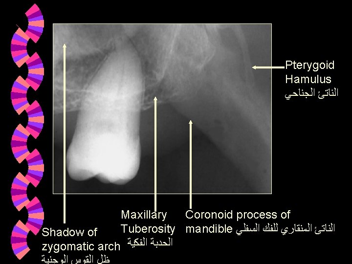 Pterygoid Hamulus ﺍﻟﻨﺎﺗﺊ ﺍﻟﺠﻨﺎﺣﻲ Maxillary Coronoid process of Tuberosity mandible ﺍﻟﻨﺎﺗﺊ ﺍﻟﻤﻨﻘﺎﺭﻱ ﻟﻠﻔﻚ ﺍﻟﺴﻔﻠﻲ Pterygoid Hamulus ﺍﻟﻨﺎﺗﺊ ﺍﻟﺠﻨﺎﺣﻲ Maxillary Coronoid process of Tuberosity mandible ﺍﻟﻨﺎﺗﺊ ﺍﻟﻤﻨﻘﺎﺭﻱ ﻟﻠﻔﻚ ﺍﻟﺴﻔﻠﻲ