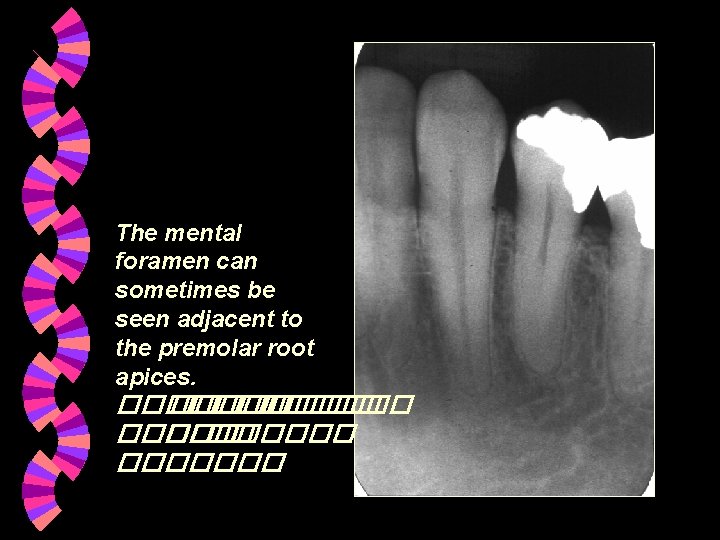 The mental foramen can sometimes be seen adjacent to the premolar root apices. ������� The mental foramen can sometimes be seen adjacent to the premolar root apices. �������