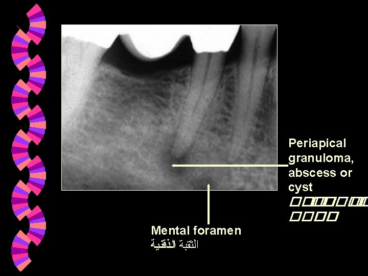 Periapical granuloma, abscess or cyst ��� �� ���� �� Mental foramen ﺍﻟﺜﻘﺒﺔ ﺍﻟﺬﻗﻨﻴﺔ Periapical granuloma, abscess or cyst ��� �� ���� �� Mental foramen ﺍﻟﺜﻘﺒﺔ ﺍﻟﺬﻗﻨﻴﺔ