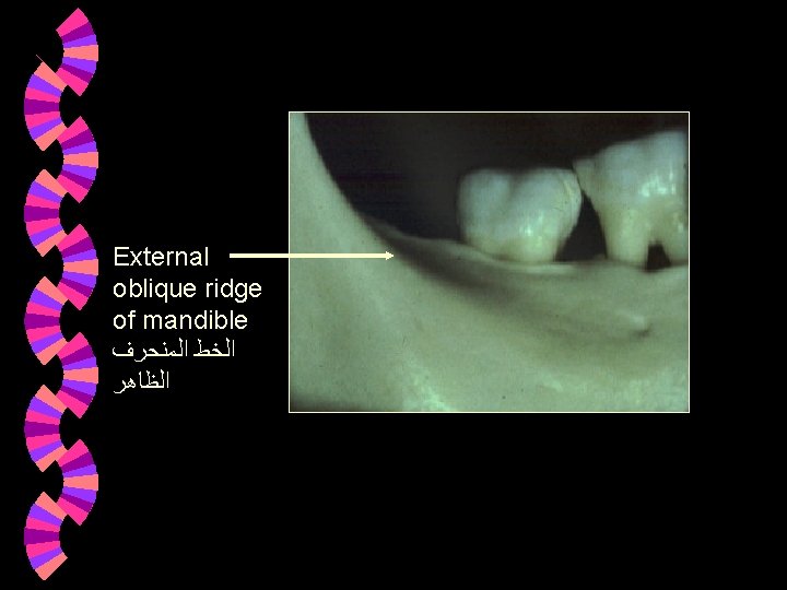 External oblique ridge of mandible ﺍﻟﺨﻂ ﺍﻟﻤﻨﺤﺮﻑ ﺍﻟﻈﺎﻫﺮ External oblique ridge of mandible ﺍﻟﺨﻂ ﺍﻟﻤﻨﺤﺮﻑ ﺍﻟﻈﺎﻫﺮ