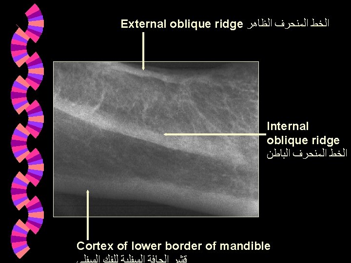 External oblique ridge ﺍﻟﺨﻂ ﺍﻟﻤﻨﺤﺮﻑ ﺍﻟﻈﺎﻫﺮ Internal oblique ridge ﺍﻟﺨﻂ ﺍﻟﻤﻨﺤﺮﻑ ﺍﻟﺒﺎﻃﻦ Cortex of External oblique ridge ﺍﻟﺨﻂ ﺍﻟﻤﻨﺤﺮﻑ ﺍﻟﻈﺎﻫﺮ Internal oblique ridge ﺍﻟﺨﻂ ﺍﻟﻤﻨﺤﺮﻑ ﺍﻟﺒﺎﻃﻦ Cortex of