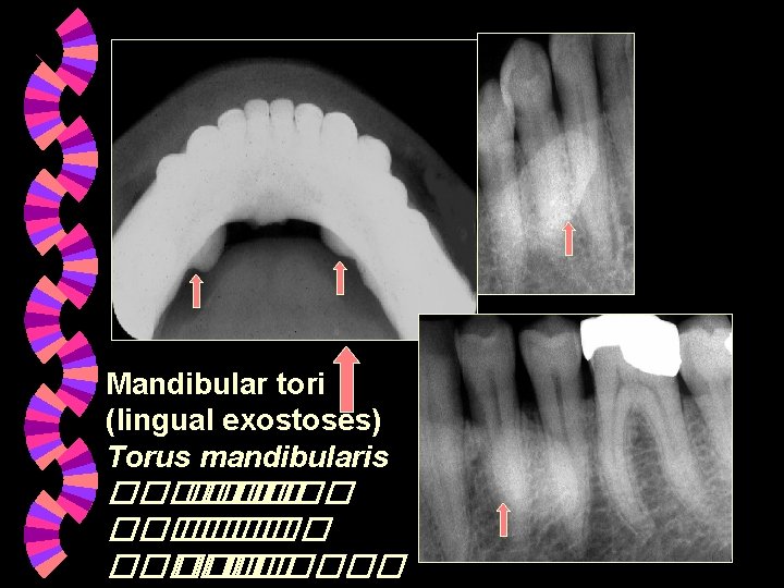 Mandibular tori (lingual exostoses) Torus mandibularis ������ ���� ������ Mandibular tori (lingual exostoses) Torus mandibularis ������ ���� ������