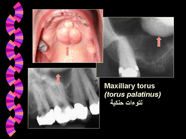Maxillary torus (torus palatinus) ﻧﺘﻮﺀﺍﺕ ﺣﻨﻜﻴﺔ Maxillary torus (torus palatinus) ﻧﺘﻮﺀﺍﺕ ﺣﻨﻜﻴﺔ