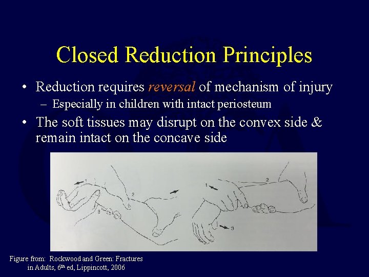 Closed Reduction Principles • Reduction requires reversal of mechanism of injury – Especially in Closed Reduction Principles • Reduction requires reversal of mechanism of injury – Especially in