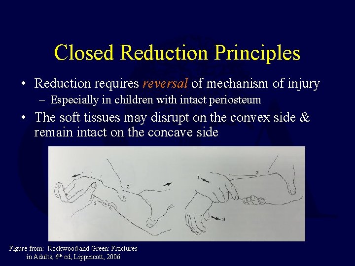 Closed Reduction Principles • Reduction requires reversal of mechanism of injury – Especially in