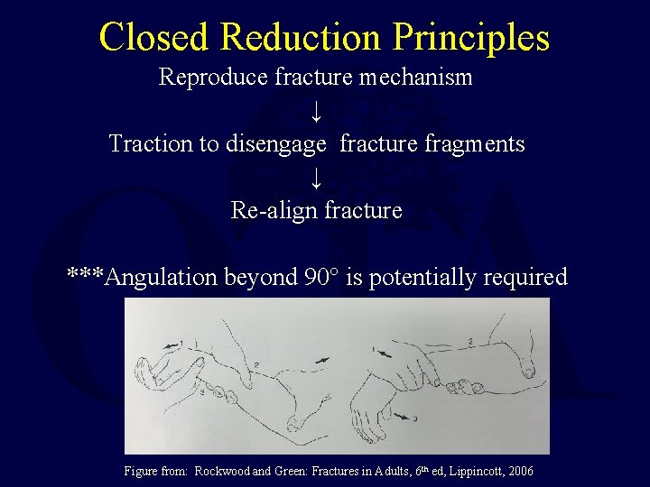 Closed Reduction Principles Reproduce fracture mechanism ↓ Traction to disengage fracture fragments ↓ Re-align