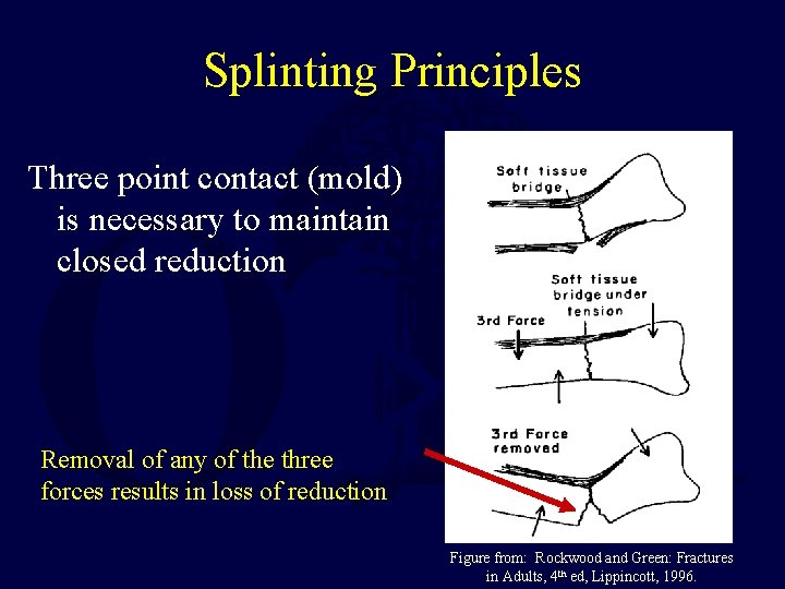 Splinting Principles Three point contact (mold) is necessary to maintain closed reduction Removal of Splinting Principles Three point contact (mold) is necessary to maintain closed reduction Removal of