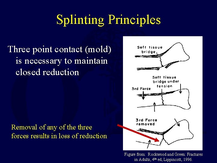 Splinting Principles Three point contact (mold) is necessary to maintain closed reduction Removal of